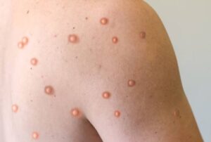 Primer caso de viruela del mono Clado Ib en Argentina