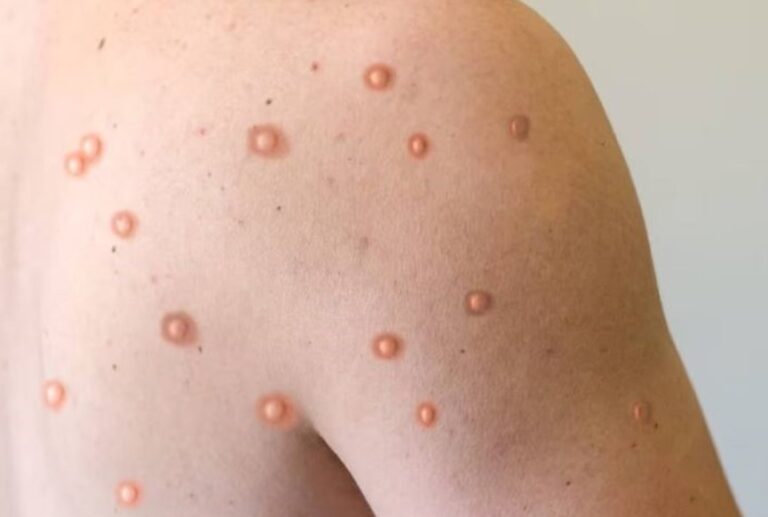 Primer caso de viruela del mono Clado Ib en Argentina