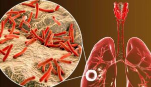 Alerta por tuberculosis en Argentina: suben los contagios en 2026