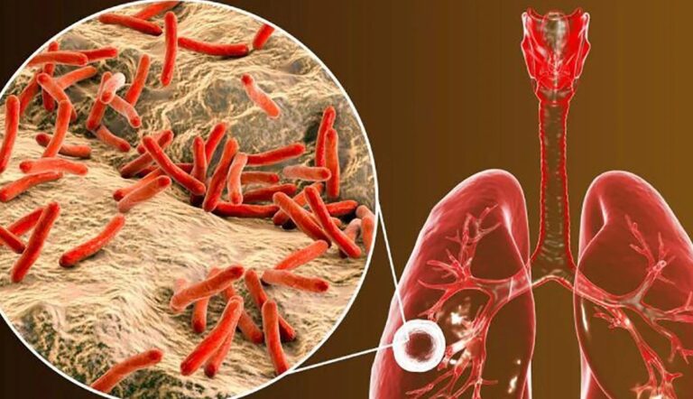 Alerta por tuberculosis en Argentina: suben los contagios en 2026